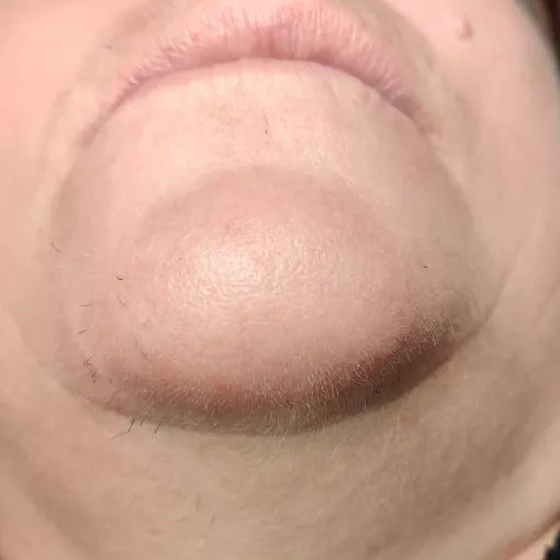 Après plusieurs séances d’épilation par électrolyse sur le menton, montrant une diminution visible des poils et une peau plus nette.