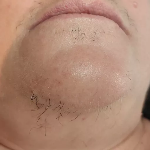 Avant une épilation définitive par électrolyse sur le menton, montrant la pilosité avant traitement, tous types de peaux et de poils.