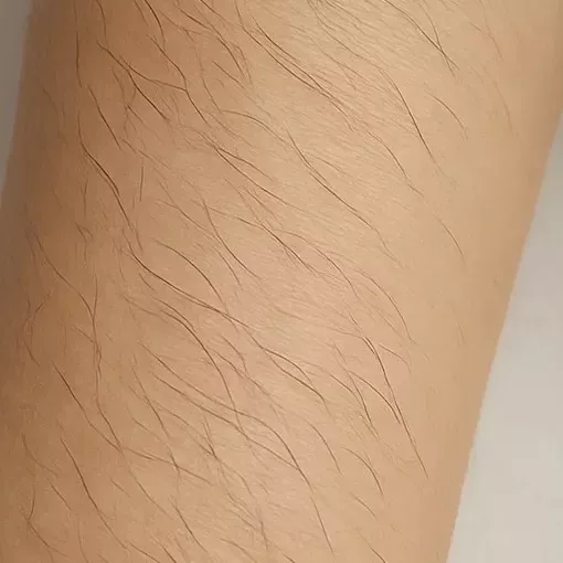 Peau lisse avant une séance d’épilation définitive par électrolyse